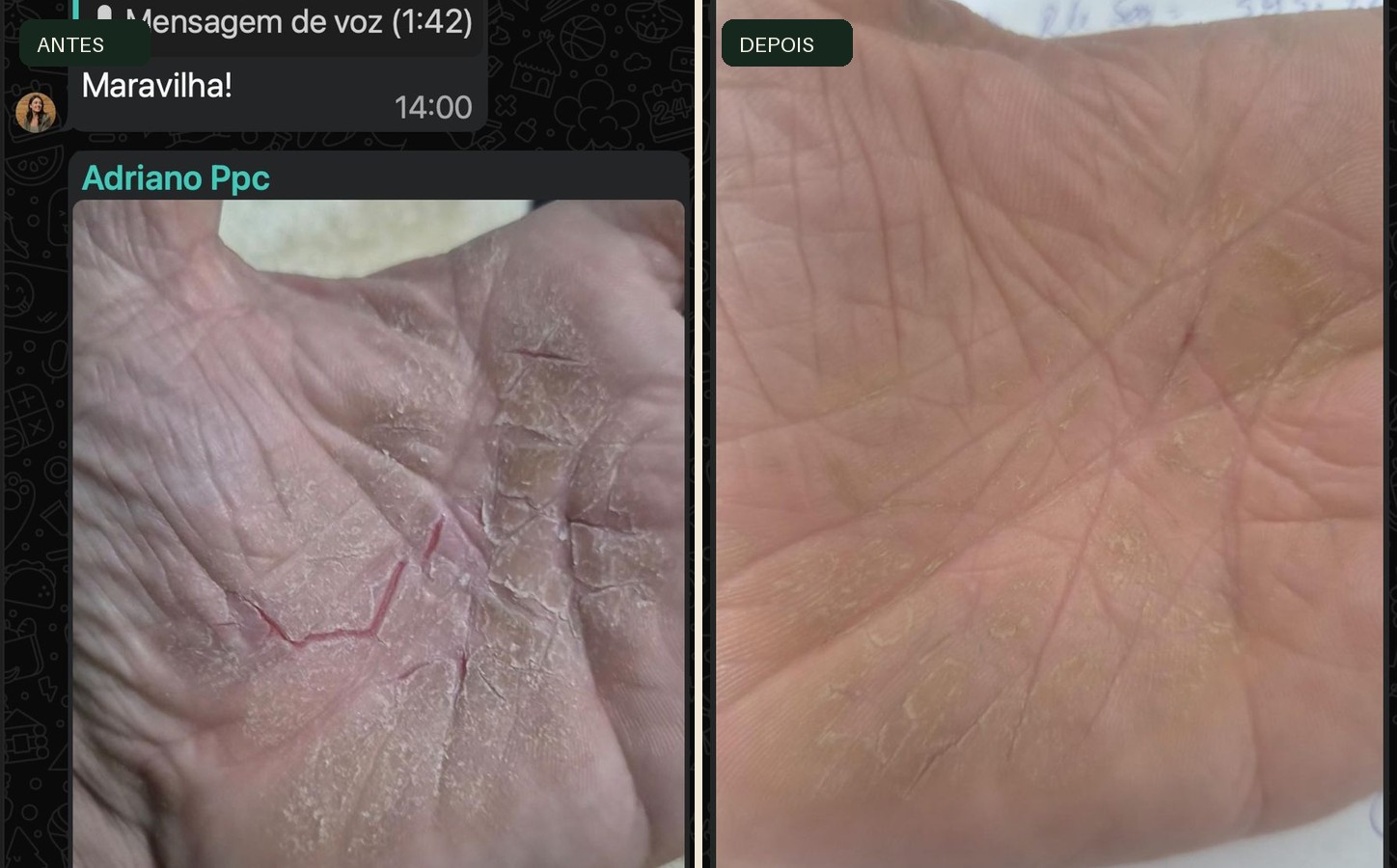 Comparativo da palma da mão antes e depois do protocolo