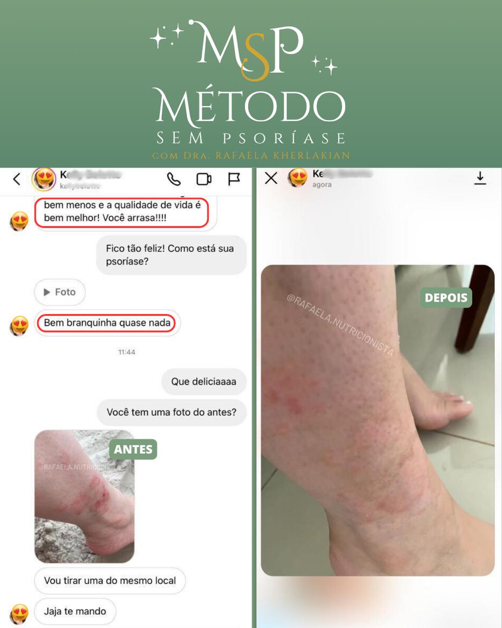 Comparativo antes e depois no tornozelo