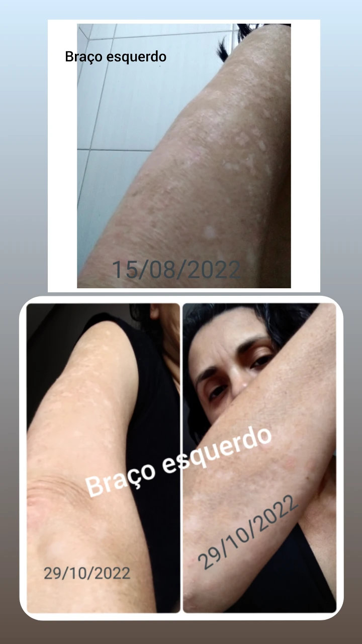Comparativo da evolução no braço